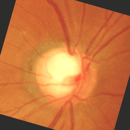 Retinal image, advanced glaucoma