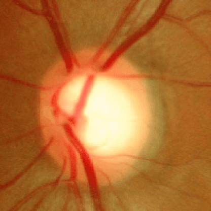 Retinal image, normal