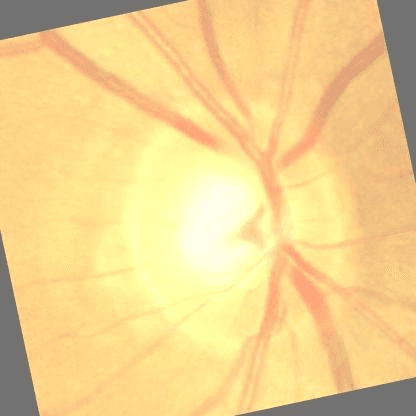Retinal image, early glaucoma